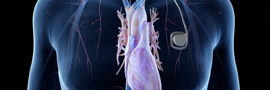 Best Cardiologist in India Answers All Your Questions About Pacemaker
