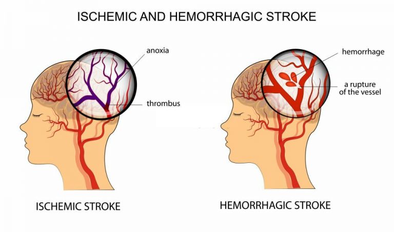 brain stoke with Ischemic Stroke and Hemorrhagic Stroke