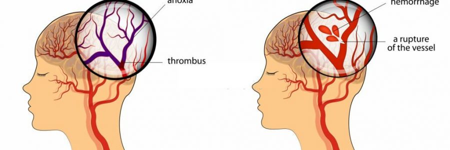 Why Brain Stoke Happens? Its Symptoms, Causes, Treatments